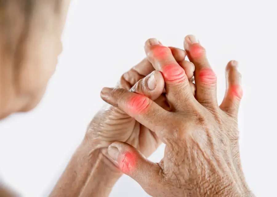 Arthritis